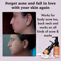 Melange Facebliss (Oily Skin)