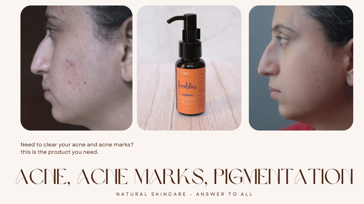 Facebliss oil for acne, pigmentation, acne marks
