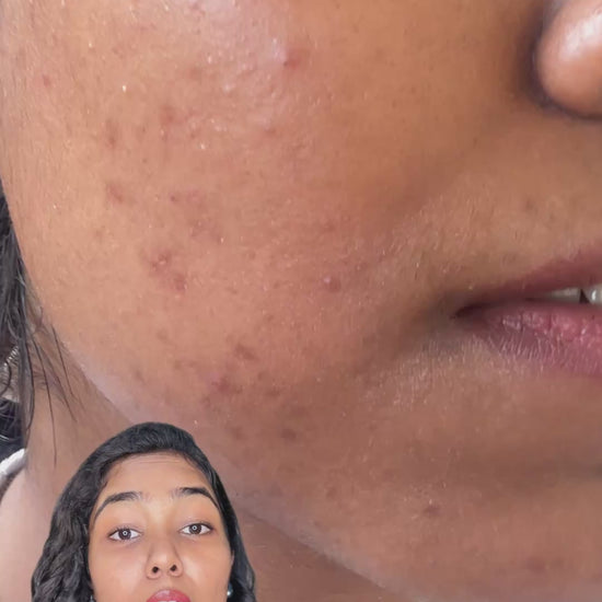 Melange Facebliss Mild – blogger before and after results, acne and acne marks reduced in just 2 weeks
