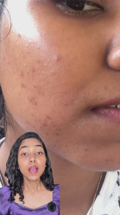Melange Facebliss Mild – blogger before and after results, acne and acne marks reduced in just 2 weeks
